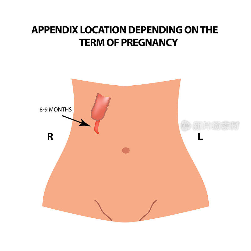 阑尾的位置取决于妊娠期。8 - 9个月。信息图。矢量插图在孤立的背景。